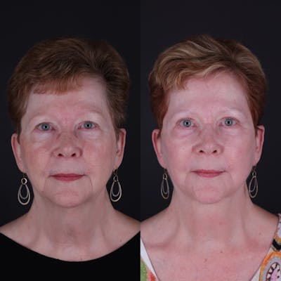 Face & Neck Lift Before & After Gallery - Patient 725619 - Image 6