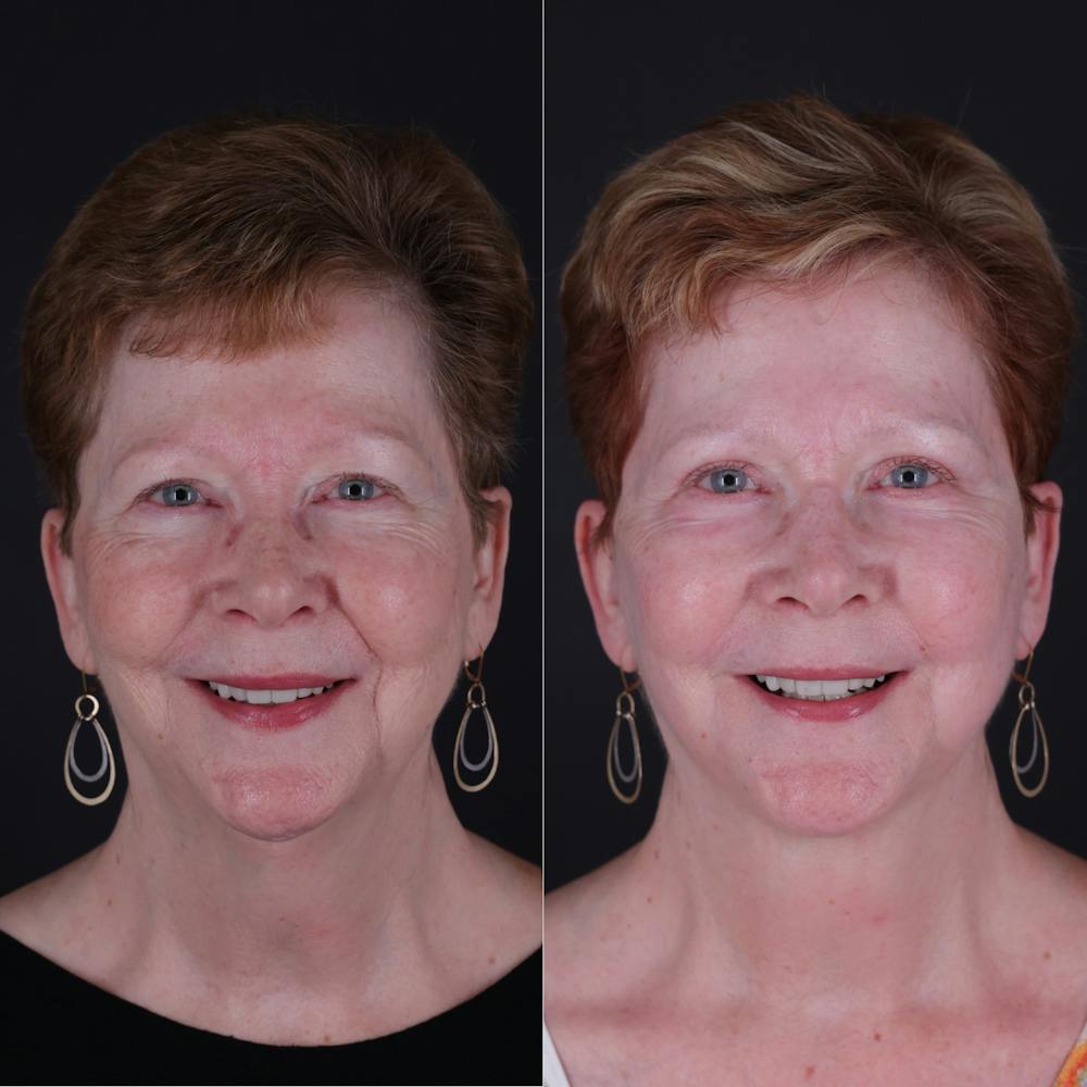 Face & Neck Lift Before & After Gallery - Patient 725619 - Image 5
