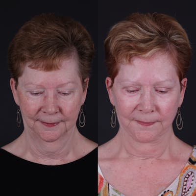 Face & Neck Lift Before & After Gallery - Patient 725619 - Image 4