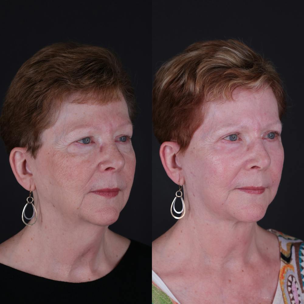 Face & Neck Lift Before & After Gallery - Patient 725619 - Image 9