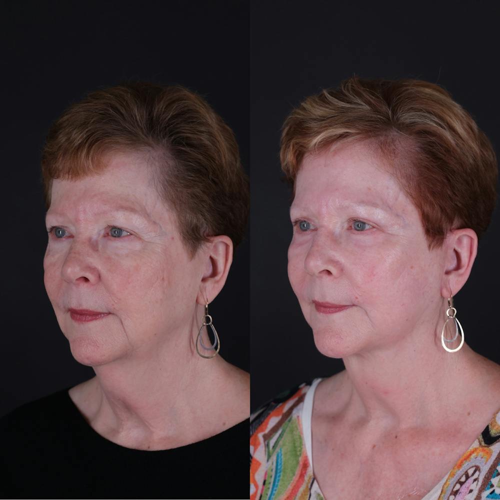 Face & Neck Lift Before & After Gallery - Patient 725619 - Image 1