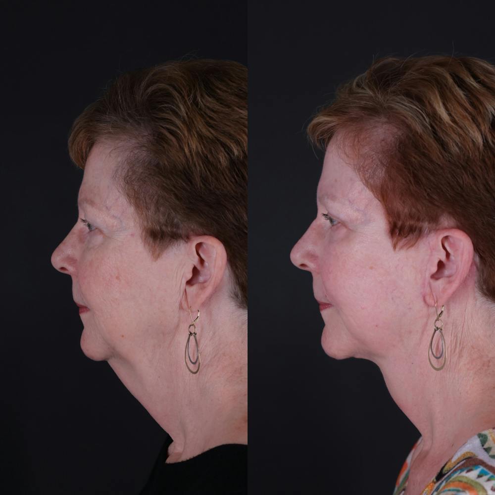 Face & Neck Lift Before & After Gallery - Patient 725619 - Image 2