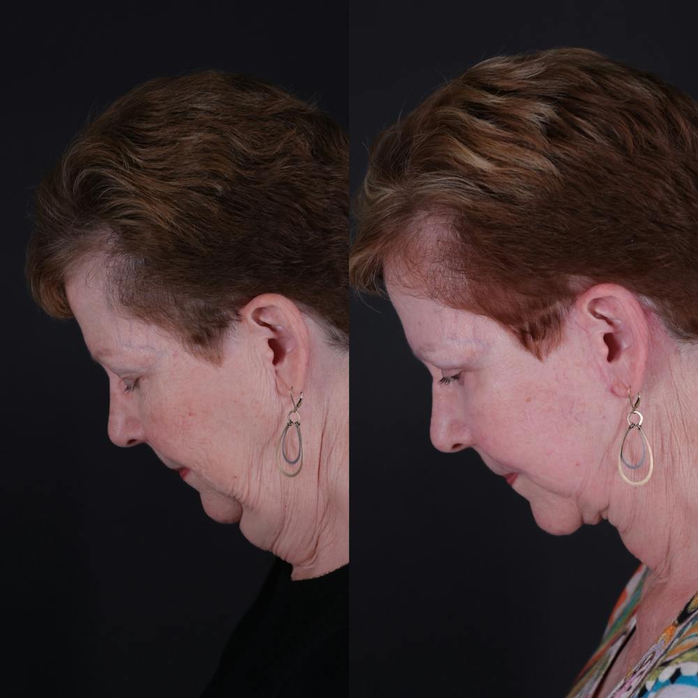 Face & Neck Lift Before & After Gallery - Patient 725619 - Image 3