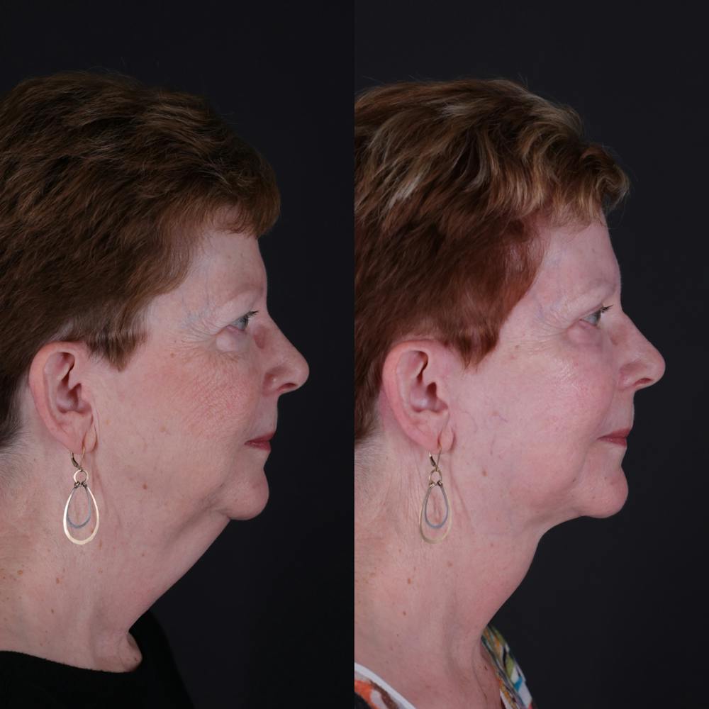 Face & Neck Lift Before & After Gallery - Patient 725619 - Image 8
