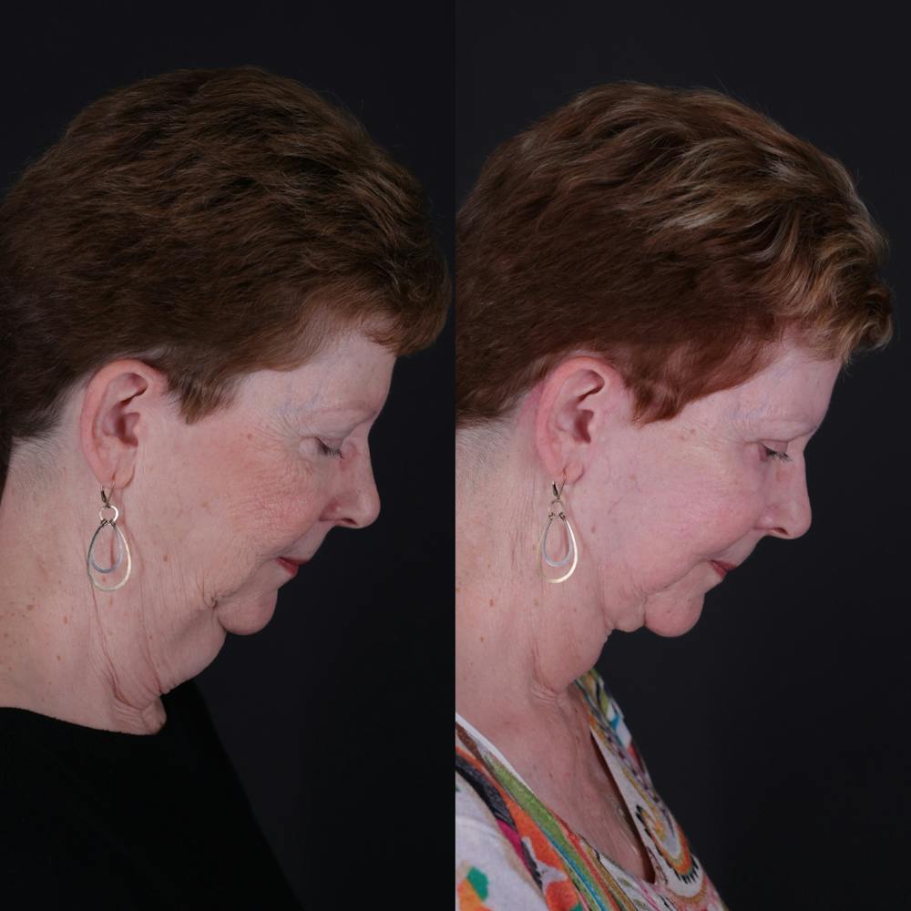 Face & Neck Lift Before & After Gallery - Patient 725619 - Image 7