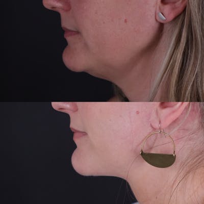 Face & Neck Lift Before & After Gallery - Patient 153967 - Image 4