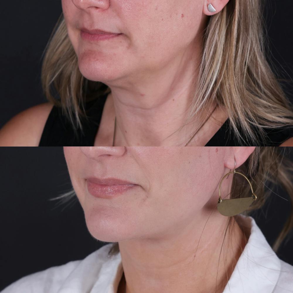 Face & Neck Lift Before & After Gallery - Patient 153967 - Image 1