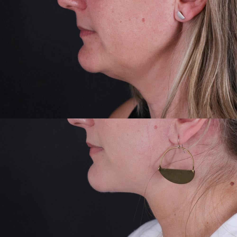 Face & Neck Lift Before & After Gallery - Patient 153967 - Image 3