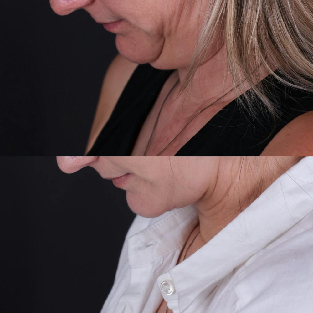 Face & Neck Lift Before & After Gallery - Patient 153967 - Image 2