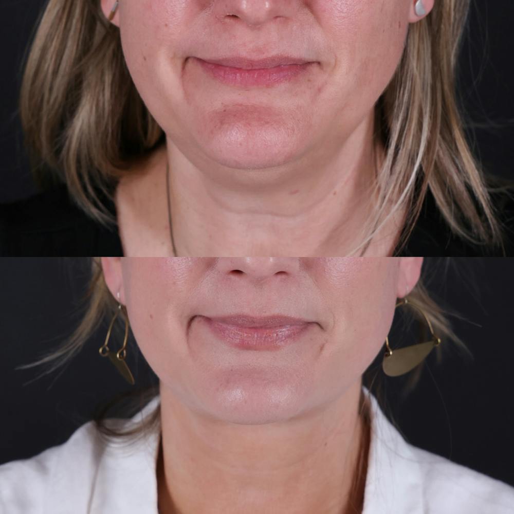 Face & Neck Lift Before & After Gallery - Patient 153967 - Image 6