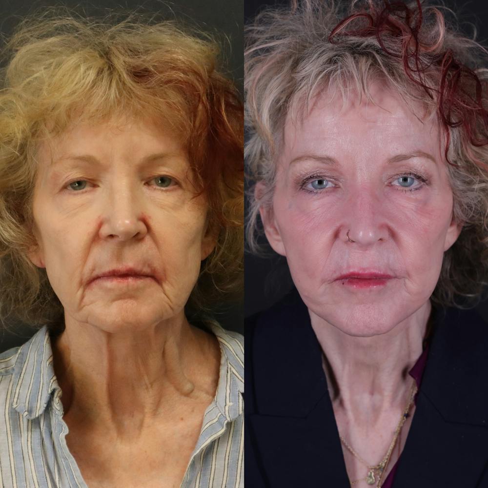 Face & Neck Lift Before & After Gallery - Patient 127287 - Image 5