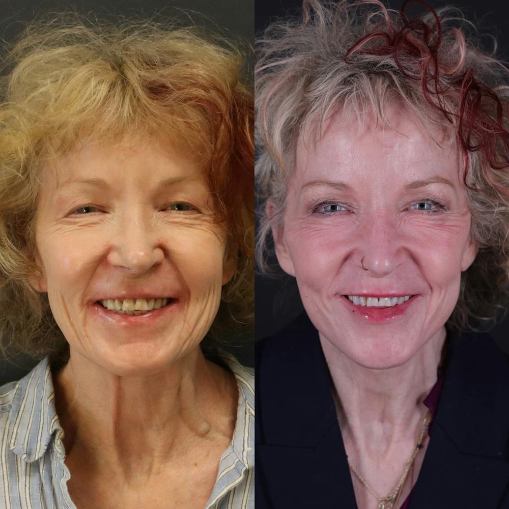 Face & Neck Lift Before & After Gallery - Patient 127287 - Image 6