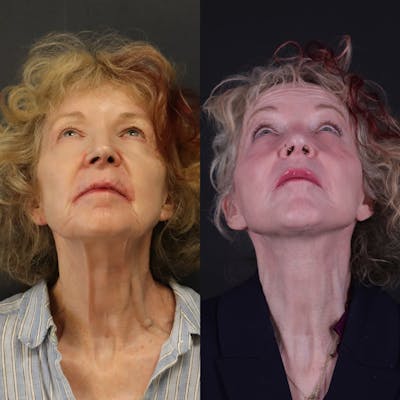 Face & Neck Lift Before & After Gallery - Patient 127287 - Image 4