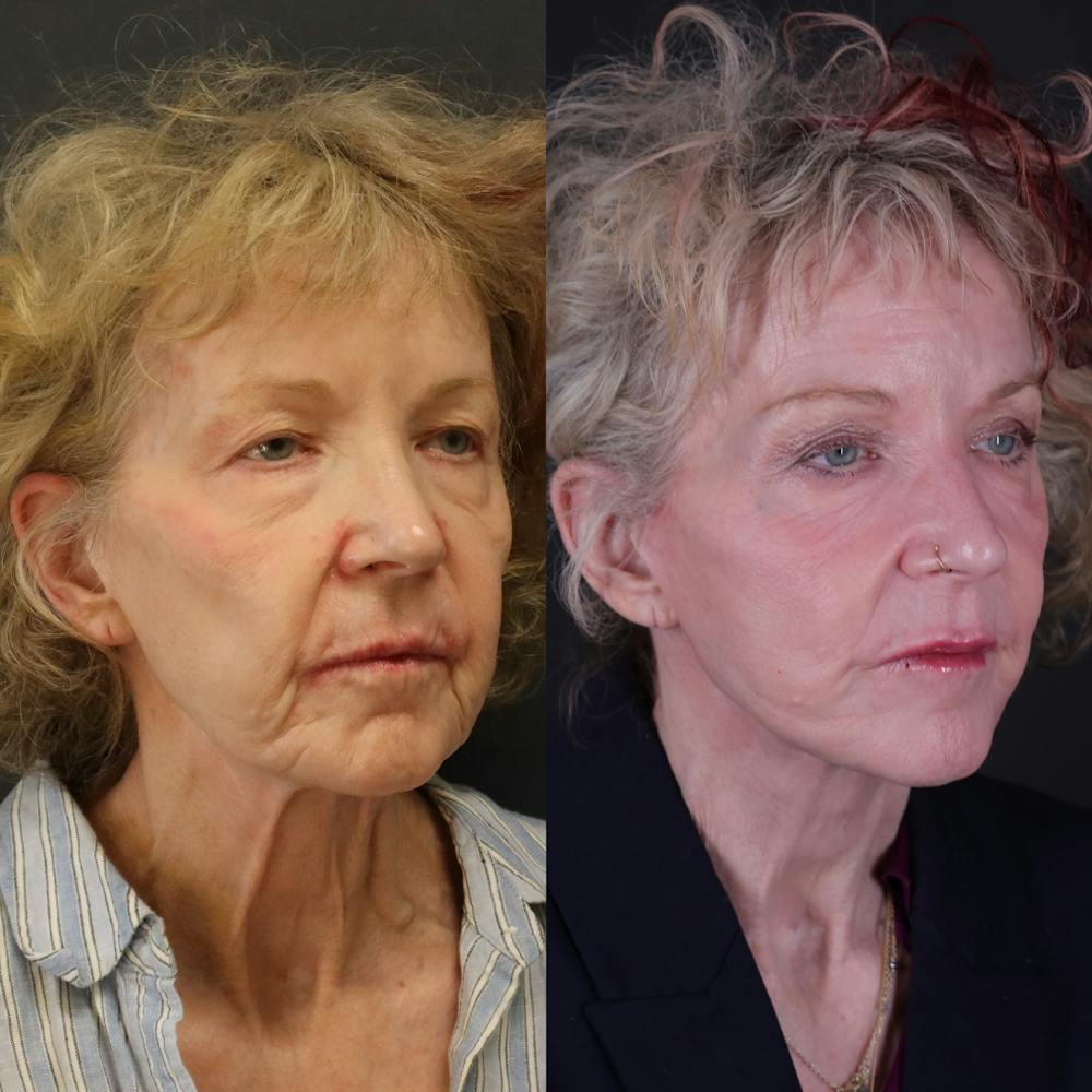 Face & Neck Lift Before & After Gallery - Patient 127287 - Image 8