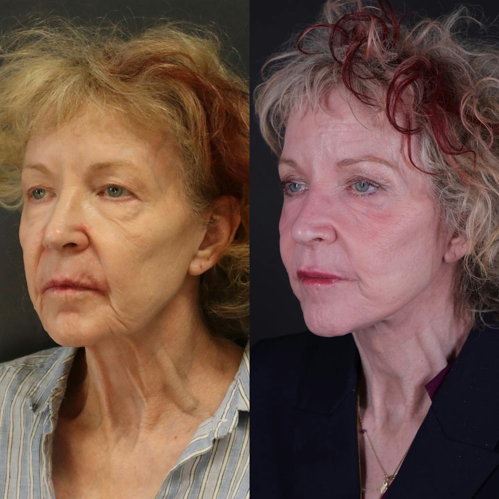 Face & Neck Lift Before & After Gallery - Patient 127287 - Image 1