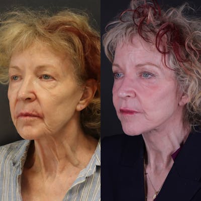 Face & Neck Lift Before & After Gallery - Patient 127287 - Image 1