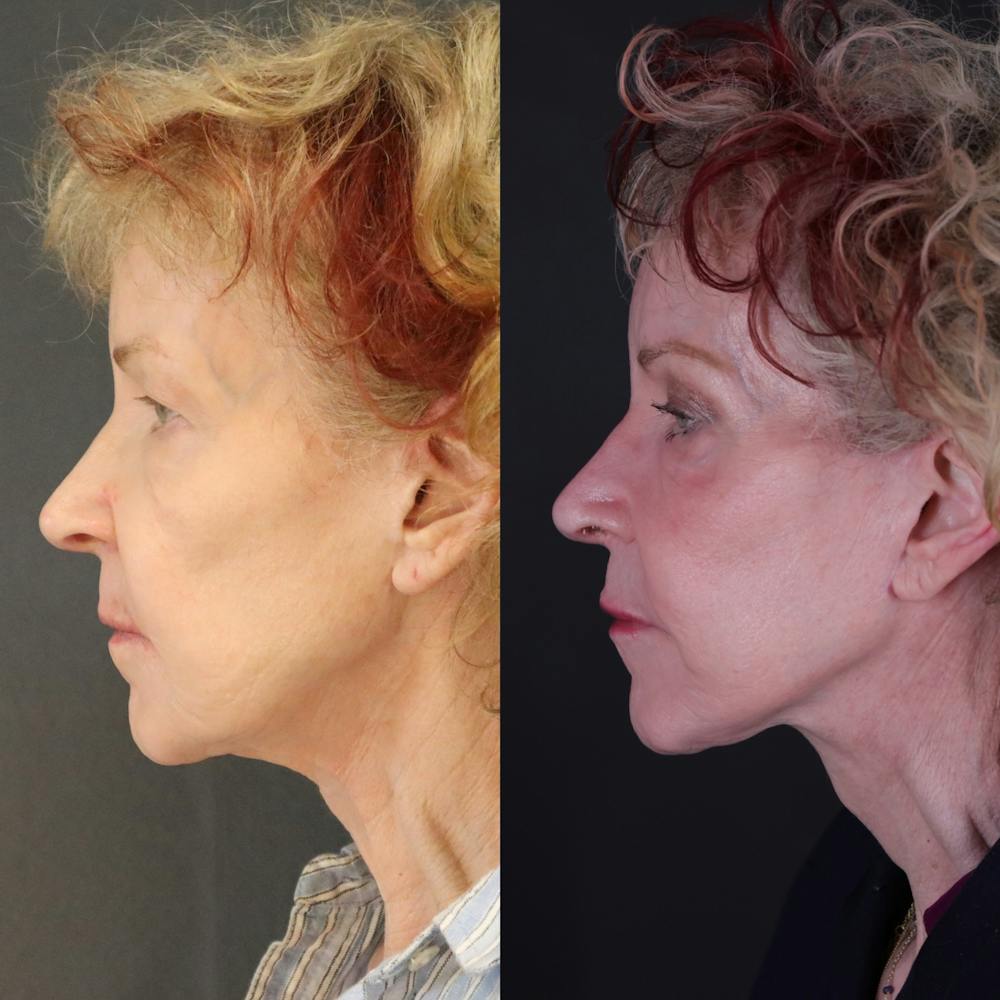Face & Neck Lift Before & After Gallery - Patient 127287 - Image 3