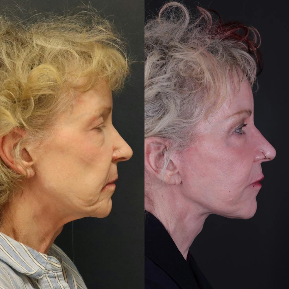 Face & Neck Lift Before & After Gallery - Patient 127287 - Image 7