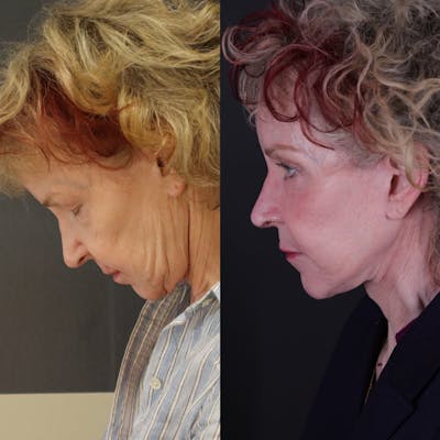 Face & Neck Lift Before & After Gallery - Patient 127287 - Image 2