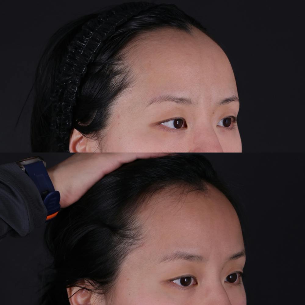 Forehead Reduction Before & After Gallery - Patient 719355 - Image 2