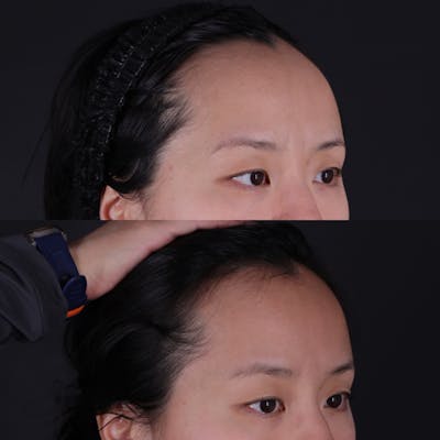 Forehead Reduction Before & After Gallery - Patient 719355 - Image 2