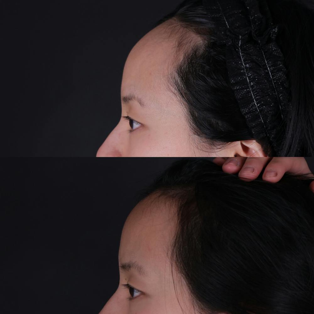 Forehead Reduction Before & After Gallery - Patient 719355 - Image 4