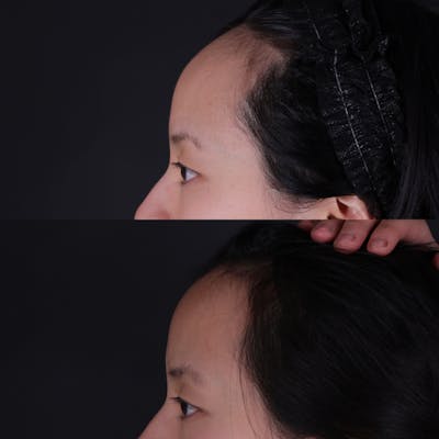 Forehead Reduction Before & After Gallery - Patient 719355 - Image 4