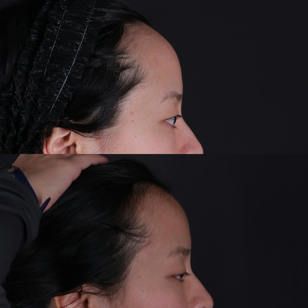 Forehead Reduction Before & After Gallery - Patient 719355 - Image 3