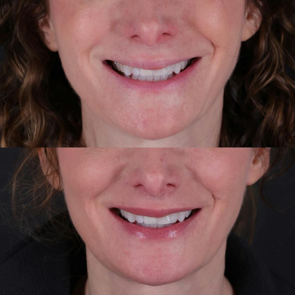 Lip Lift Before & After Gallery - Patient 303986 - Image 2