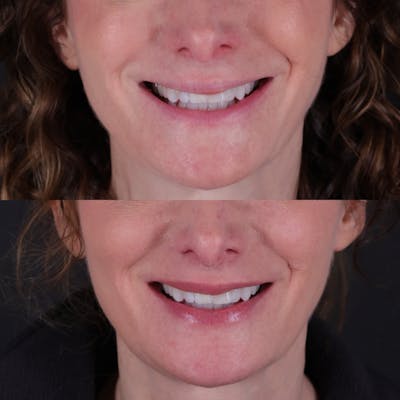 Lip Lift Before & After Gallery - Patient 303986 - Image 2