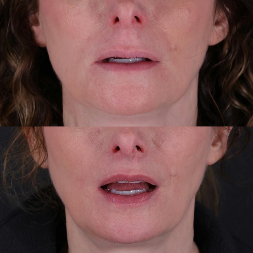 Lip Lift Before & After Gallery - Patient 303986 - Image 3