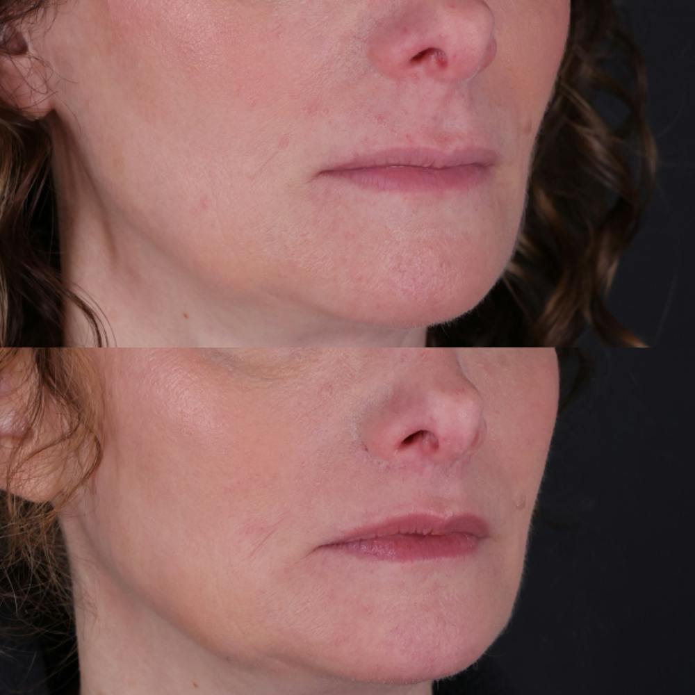 Lip Lift Before & After Gallery - Patient 303986 - Image 6