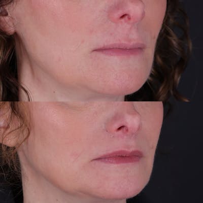 Lip Lift Before & After Gallery - Patient 303986 - Image 6