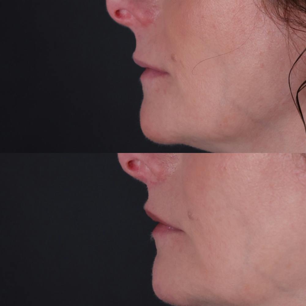 Lip Lift Before & After Gallery - Patient 303986 - Image 5