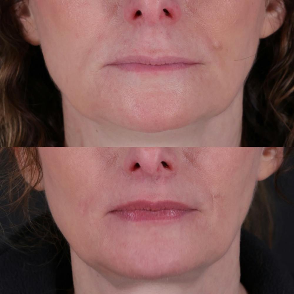 Lip Lift Before & After Gallery - Patient 303986 - Image 1