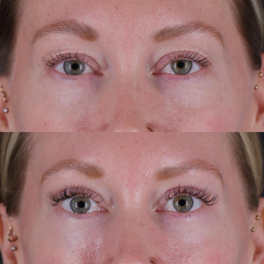 Lower Blepharoplasty Before & After Gallery - Patient 152359 - Image 1