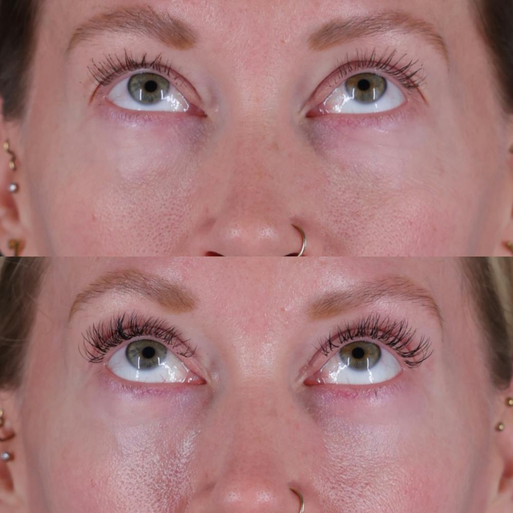 Lower Blepharoplasty Before & After Gallery - Patient 152359 - Image 2