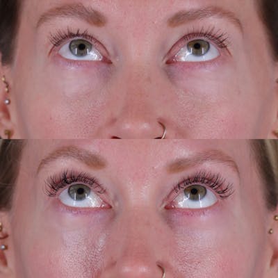 Lower Blepharoplasty Before & After Gallery - Patient 152359 - Image 2
