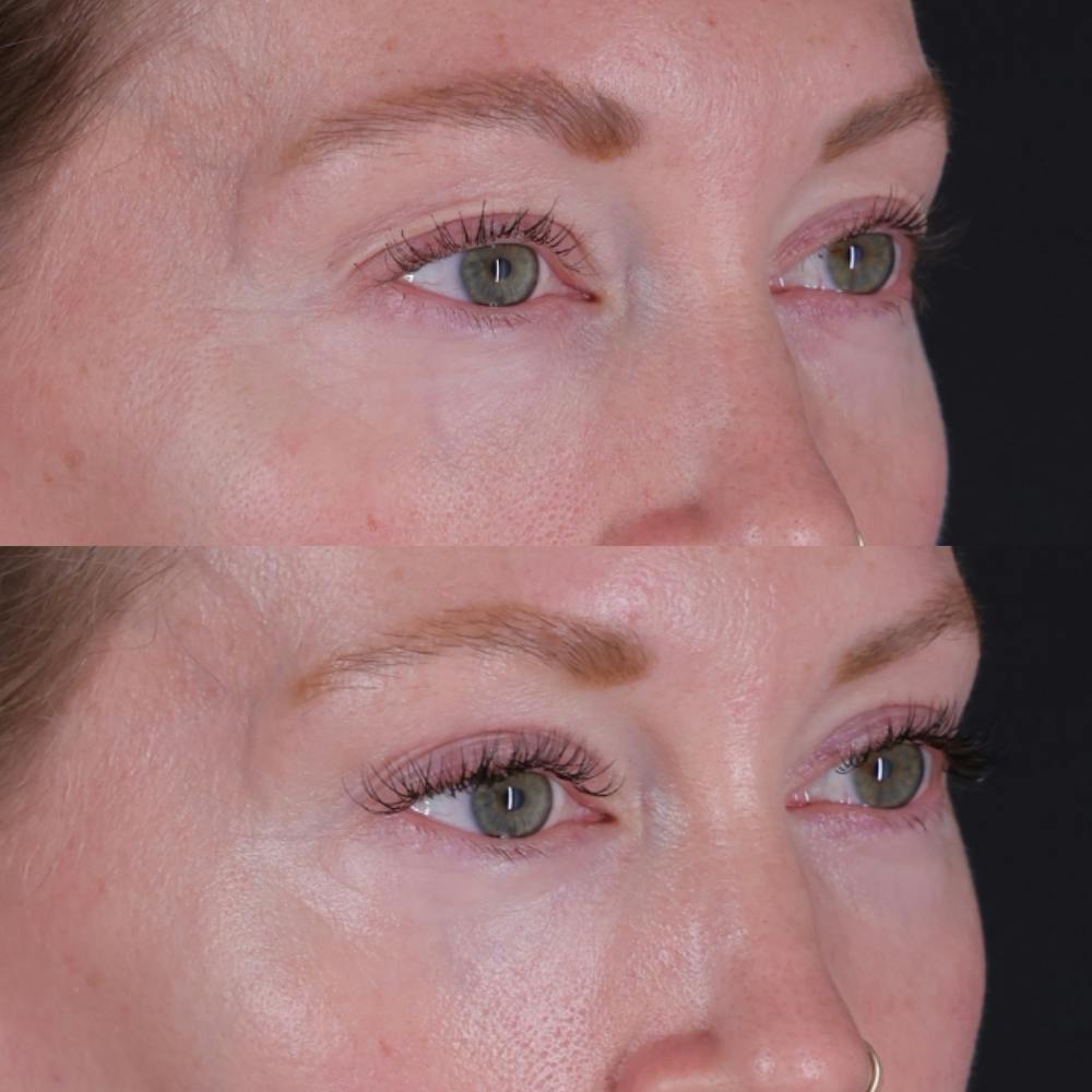 Lower Blepharoplasty Before & After Gallery - Patient 152359 - Image 4