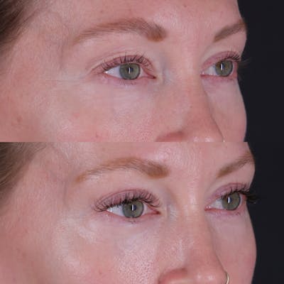 Lower Blepharoplasty Before & After Gallery - Patient 152359 - Image 4