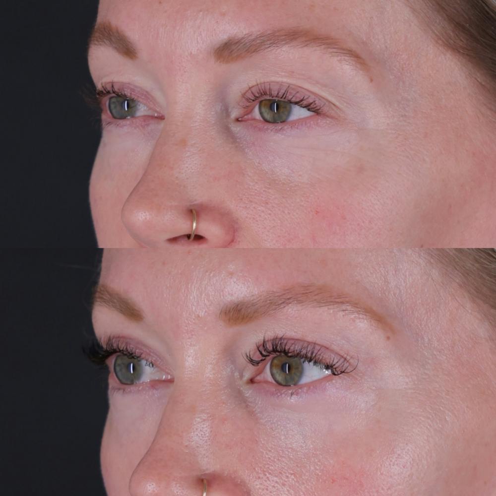 Lower Blepharoplasty Before & After Gallery - Patient 152359 - Image 3