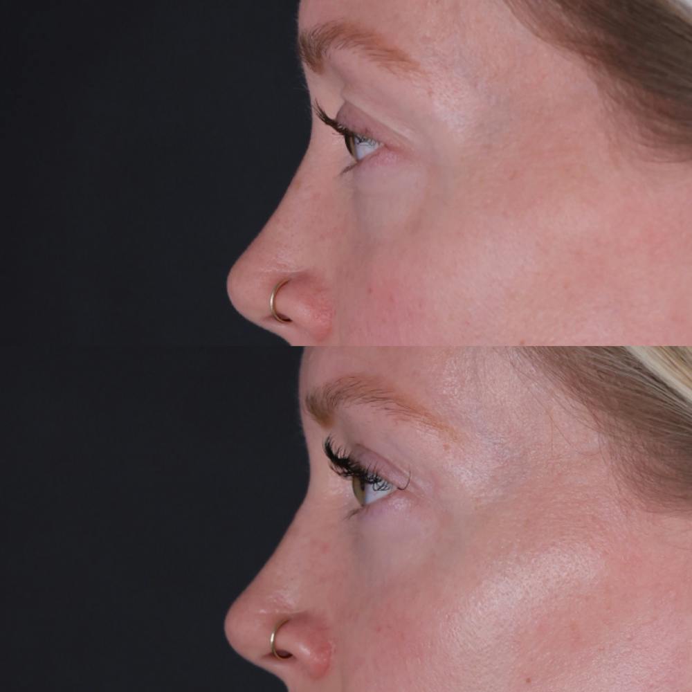 Lower Blepharoplasty Before & After Gallery - Patient 152359 - Image 6