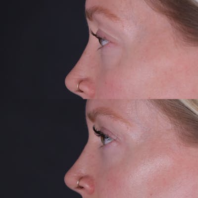 Lower Blepharoplasty Before & After Gallery - Patient 152359 - Image 6