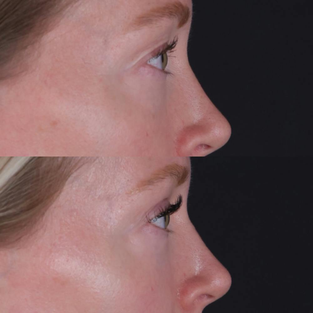 Lower Blepharoplasty Before & After Gallery - Patient 152359 - Image 5