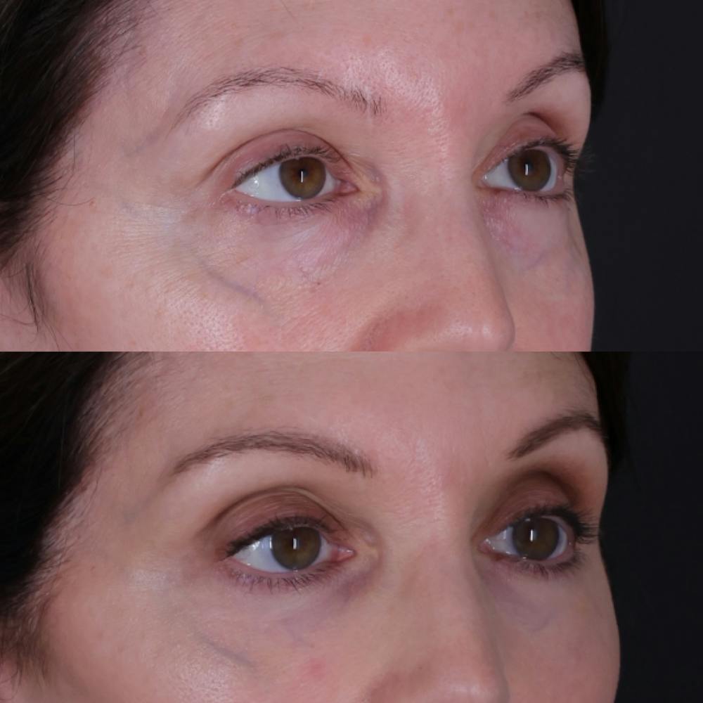 Lower Blepharoplasty Before & After Gallery - Patient 767587 - Image 4