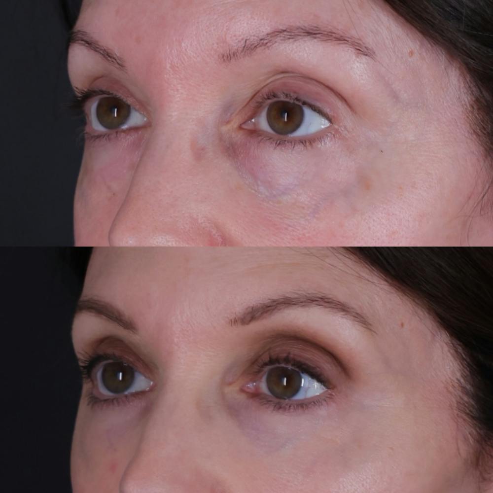Lower Blepharoplasty Before & After Gallery - Patient 767587 - Image 5