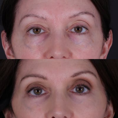 Lower Blepharoplasty Before & After Gallery - Patient 767587 - Image 2
