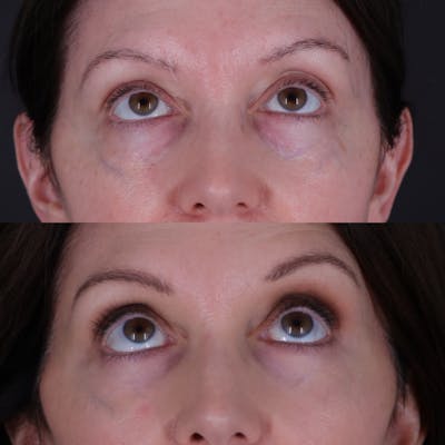 Lower Blepharoplasty Before & After Gallery - Patient 767587 - Image 1