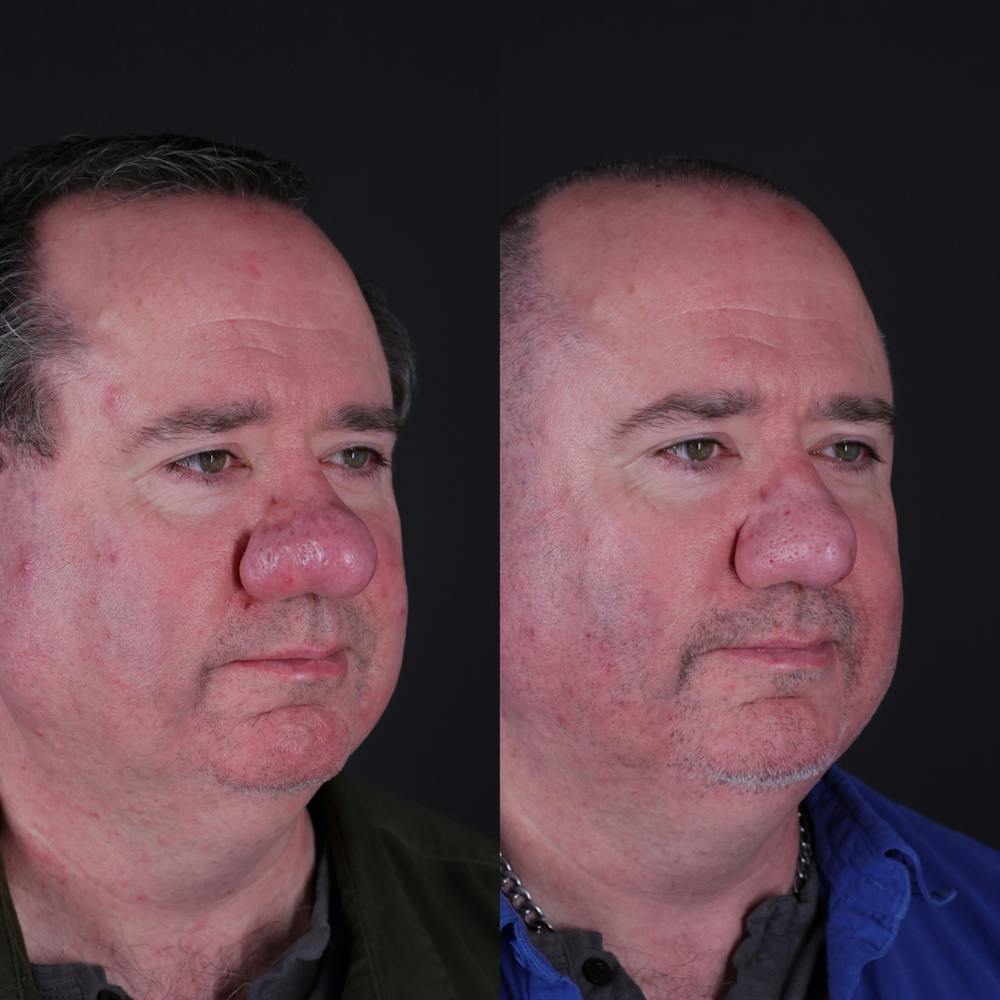 Rhinophyma Before & After Gallery - Patient 203411 - Image 5