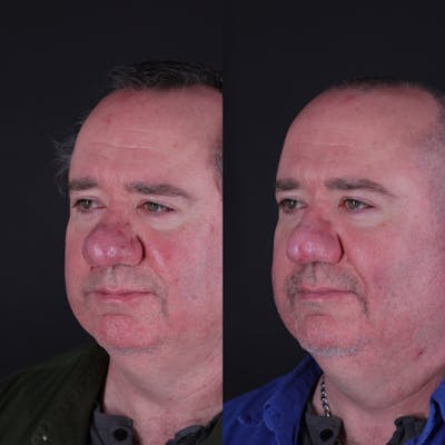 Rhinophyma Before & After Gallery - Patient 203411 - Image 1